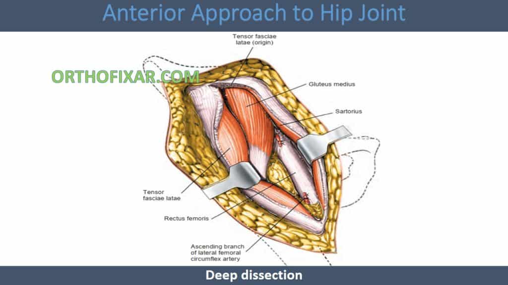 Anterior Approach to Hip Joint