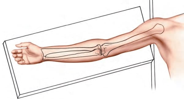 Anterior Approach to Humerus Shaft patient position
