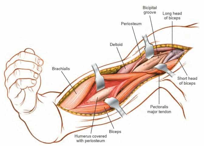 Anterior Approach To The Iliac Crest