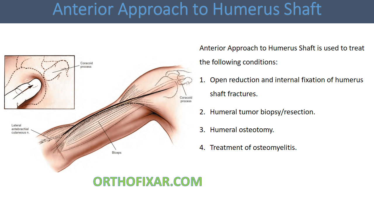 Anterior Approach to Humerus Shaft