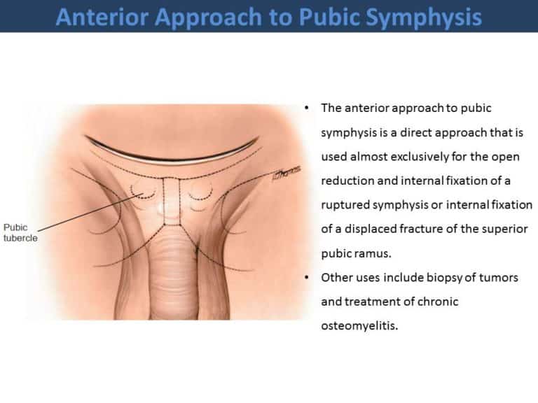 Anterior Approach to Pubic Symphysis