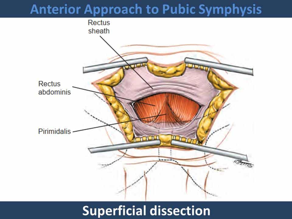 Anterior Approach to Pubic Symphysis