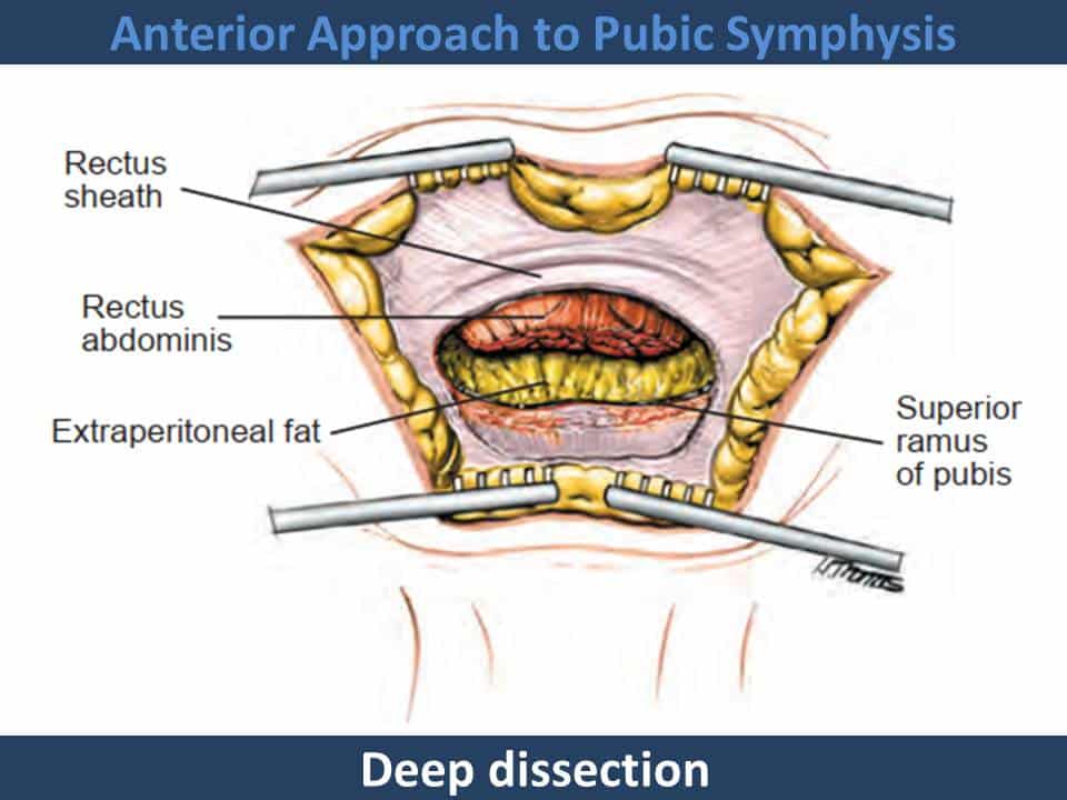 Anterior Approach to Pubic Symphysis