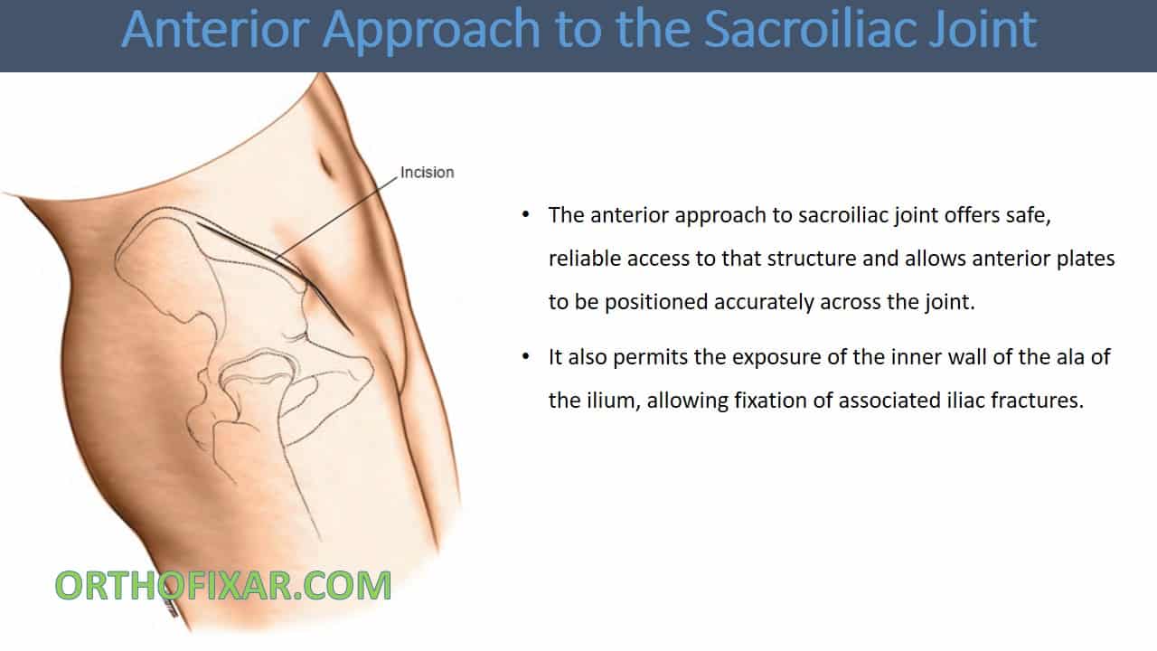  Anterior Approach to Sacroiliac Joint 