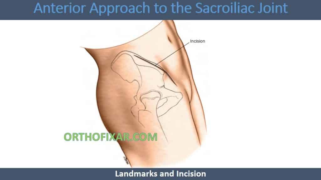 Anterior Approach to Sacroiliac Joint