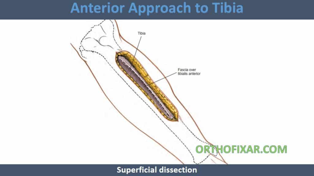 Anterior Approach to Tibia