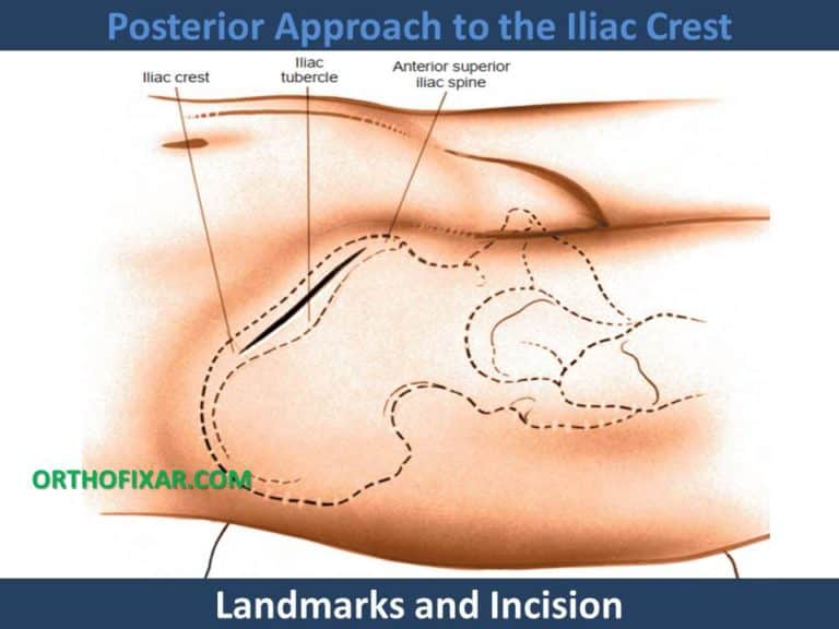 Anterior Approach To The Iliac Crest: Bone Graft Harvesting Technique ...