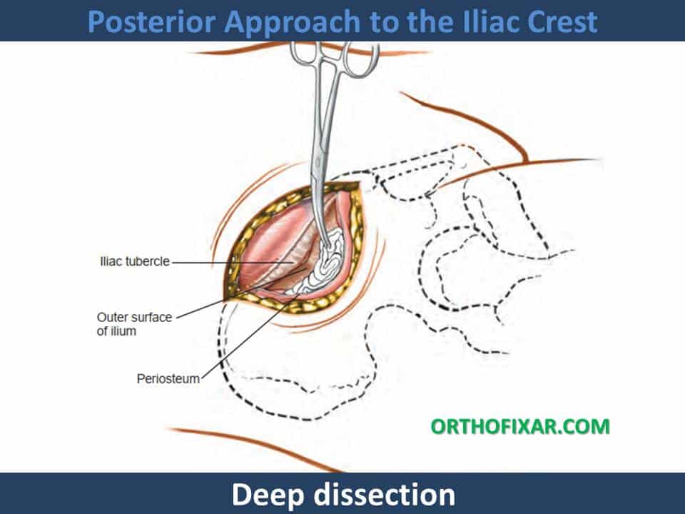 Anterior Approach to the Iliac Crest