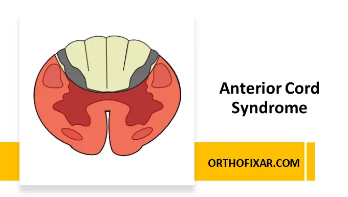 Anterior Cord Syndrome
