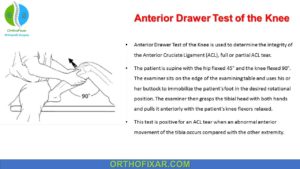 Anterior Drawer Test Of The Knee | OrthoFixar 2024