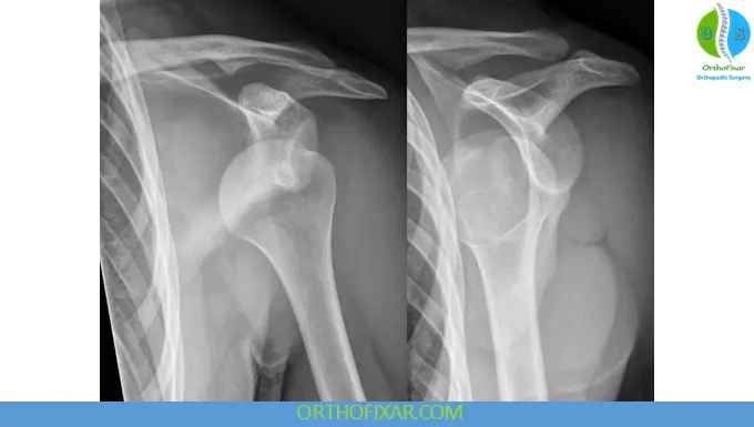 Anterior Glenohumeral Dislocation xray