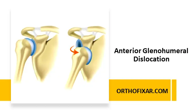 Anterior Glenohumeral Dislocation