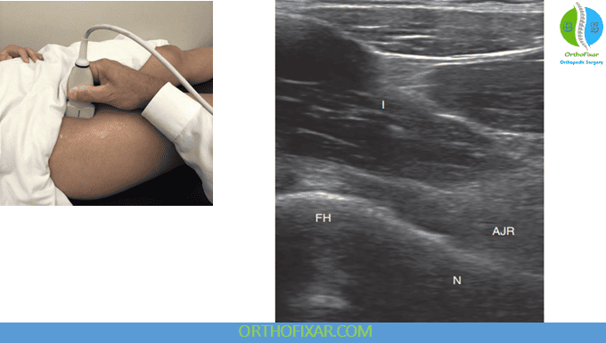 Anterior Hip Ultrasound