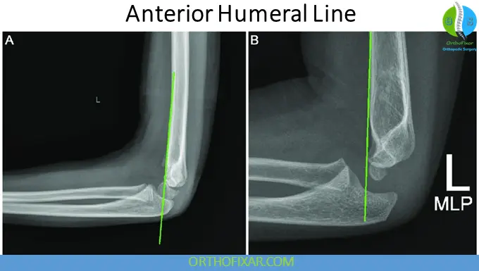 Anterior Humeral Line - Supracondylar Humerus Fractures