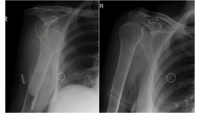 Anterior Shoulder Dislocation 4 Anterior Shoulder Dislocation imaging