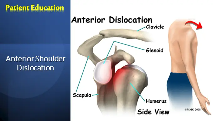 Anterior Shoulder Dislocation