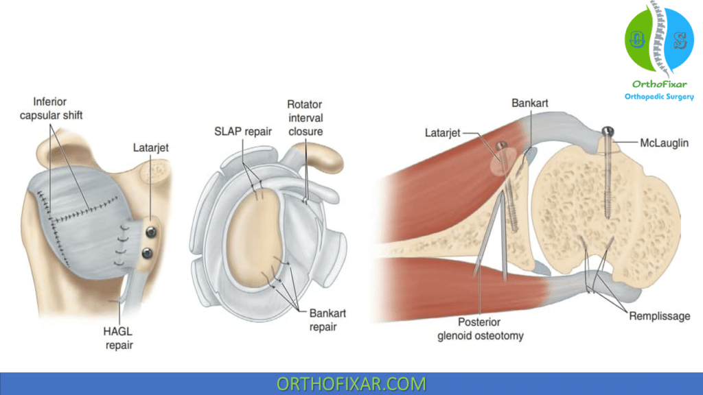 Anterior Shoulder Instability operative procedures