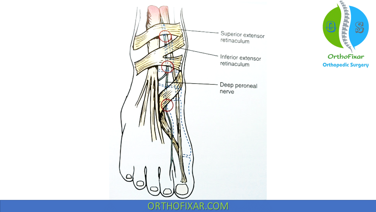 Tarsal Tunnel Syndrome Orthofixar 2024