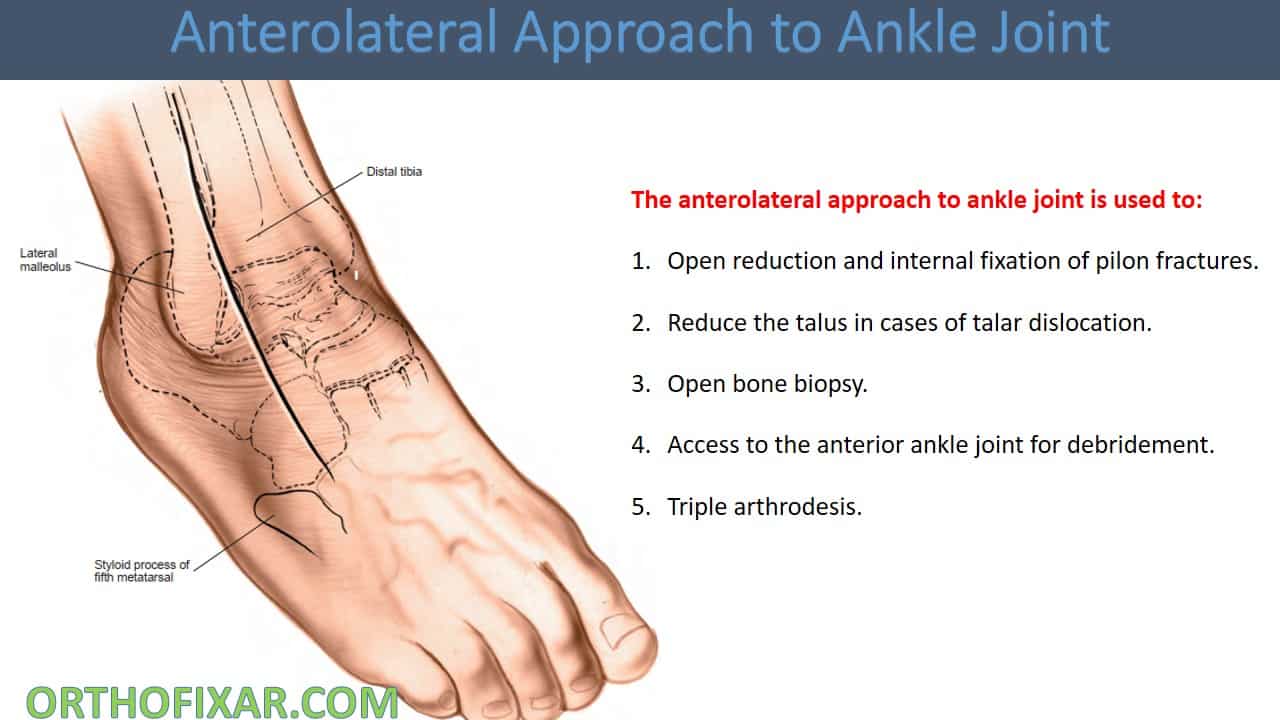  Anterolateral Approach to Ankle Joint 