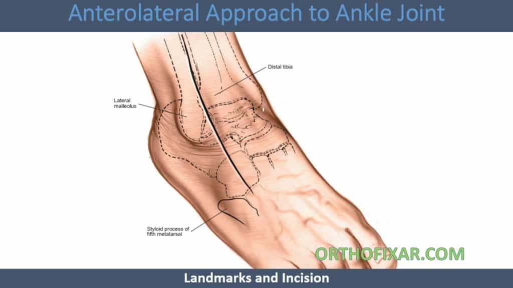Anterolateral Approach to Ankle Joint