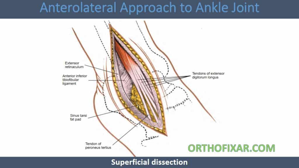 Anterolateral Approach to Ankle Joint