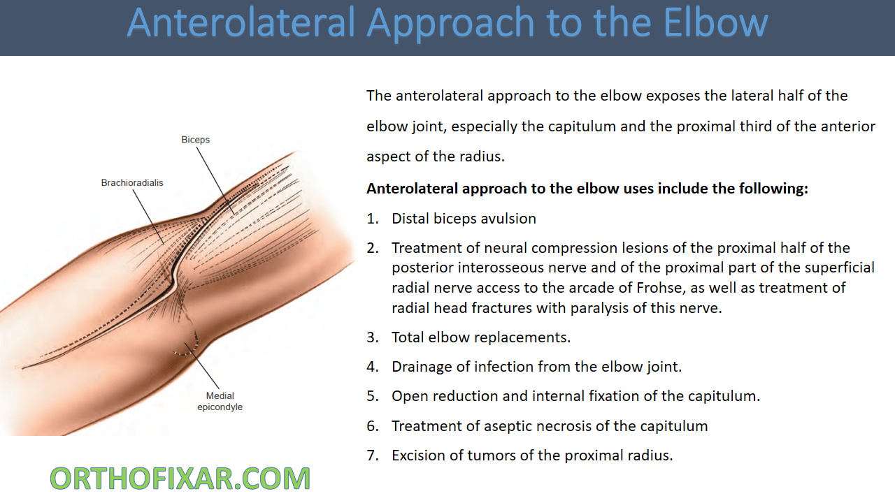  Anterolateral Approach to the Elbow 