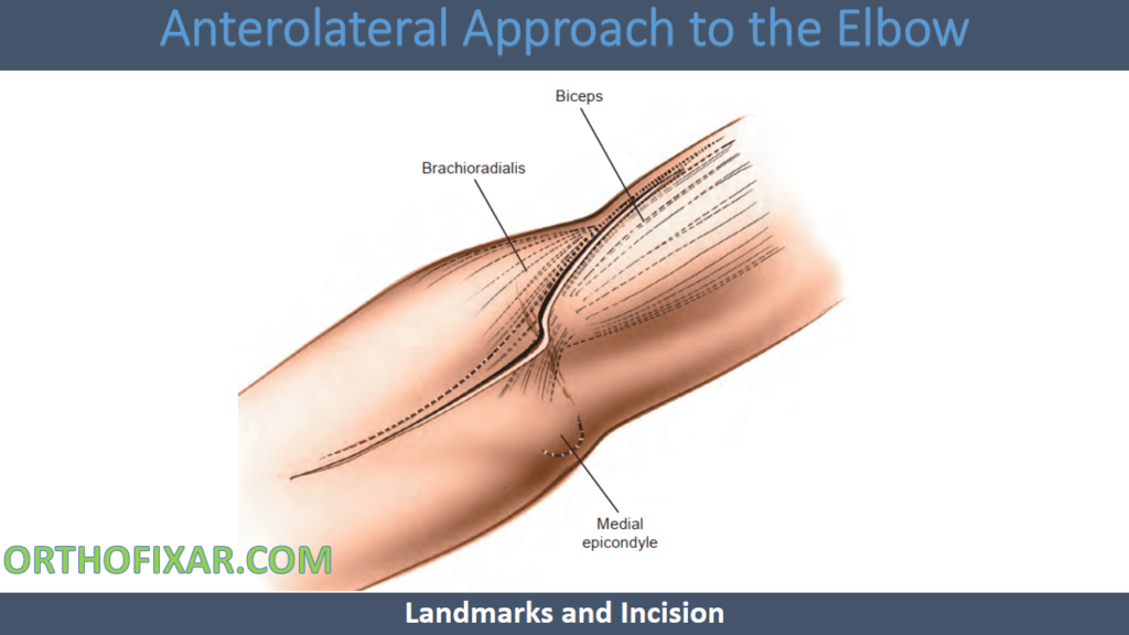 Anterolateral Approach to the Elbow