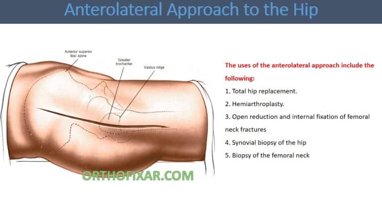 Anterolateral Approach to the Hip