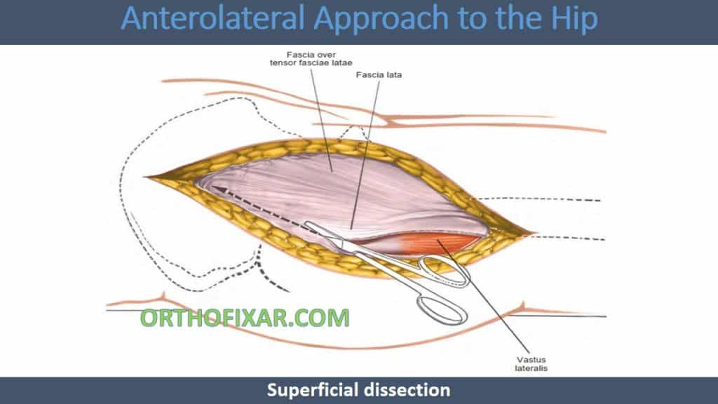 Anterolateral Approach to the Hip