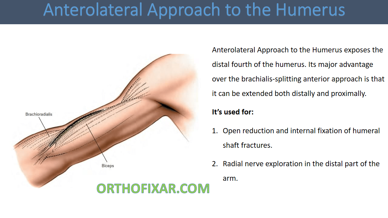  Anterolateral Approach to the Humerus 