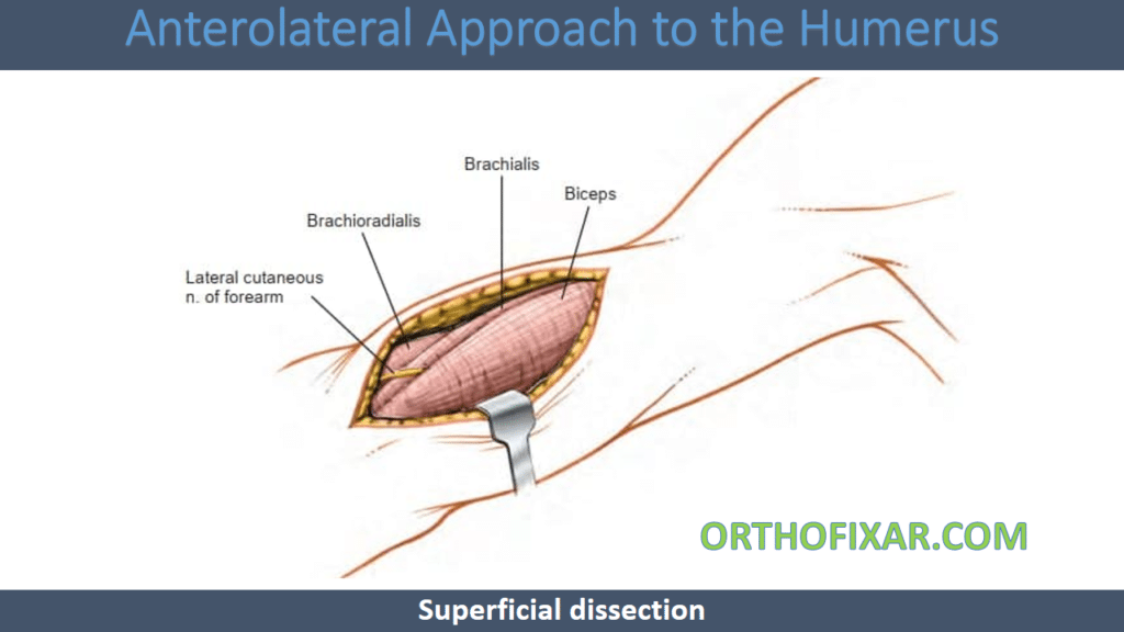 Anterolateral Approach to the Humerus