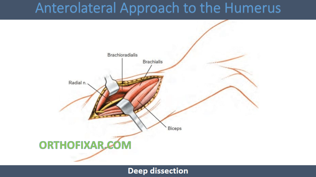 Anterolateral Approach to the Humerus