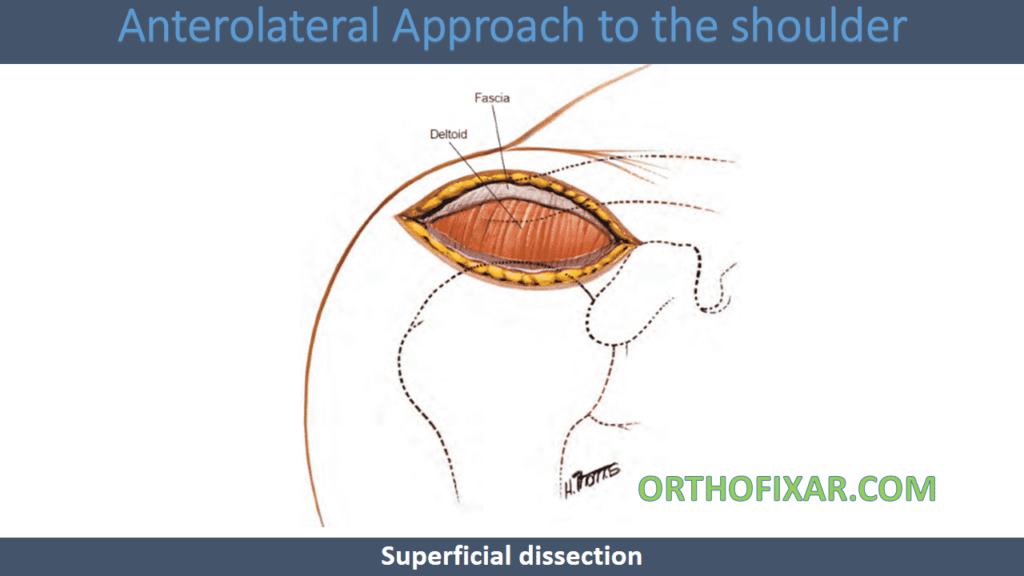 Anterolateral Approach to the shoulder