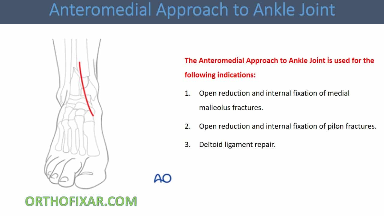  Anteromedial Approach to Ankle Joint 