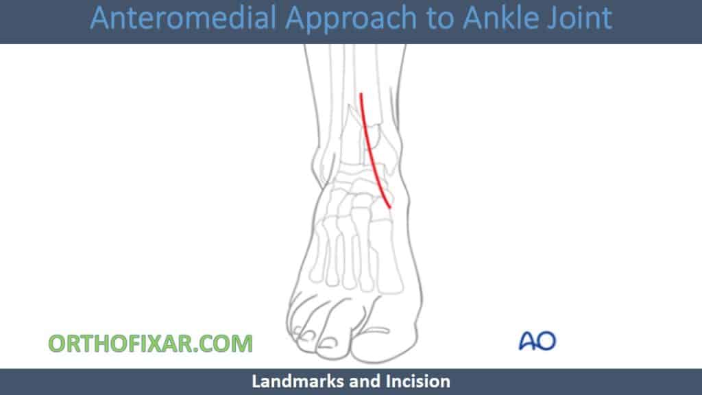 Anteromedial Approach to Ankle Joint