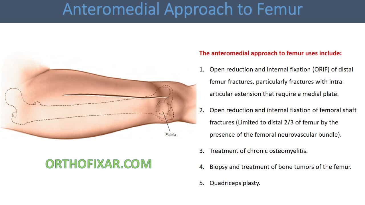  Anteromedial Approach to Femur 