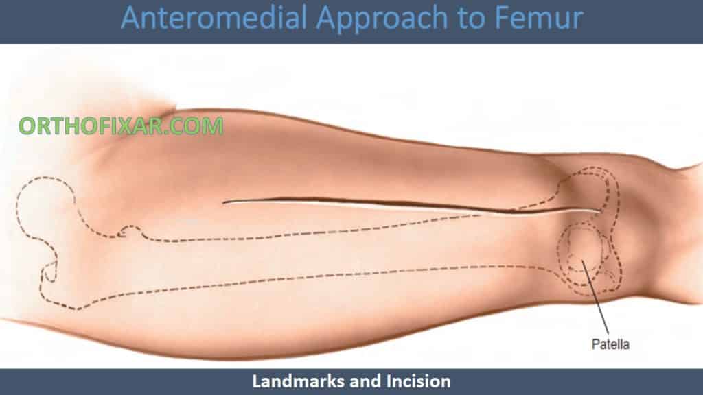 Anteromedial Approach to Femur