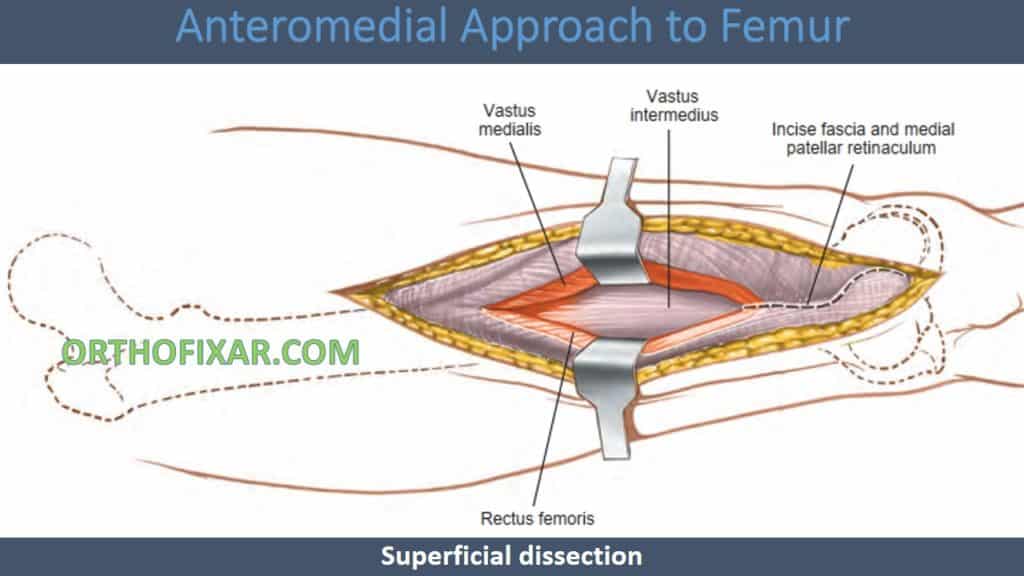 Anteromedial Approach to Femur