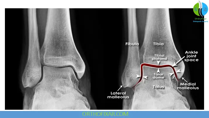 Anteroposterior (AP) View of the Ankle