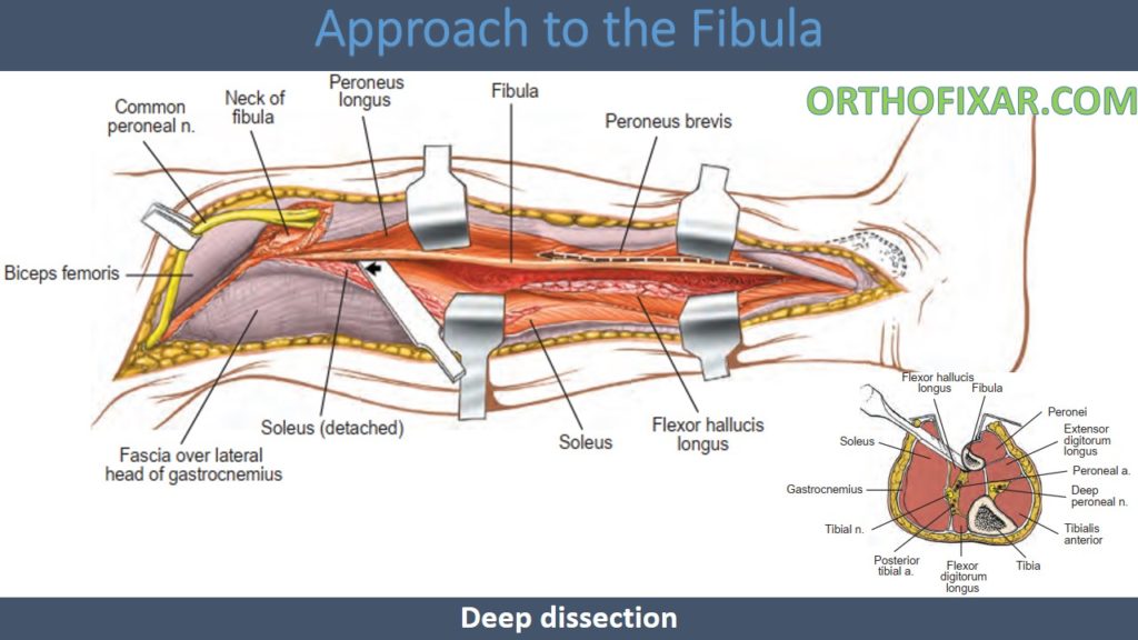 Approach to the Fibula