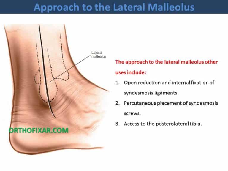 Approach to the Lateral Malleolus