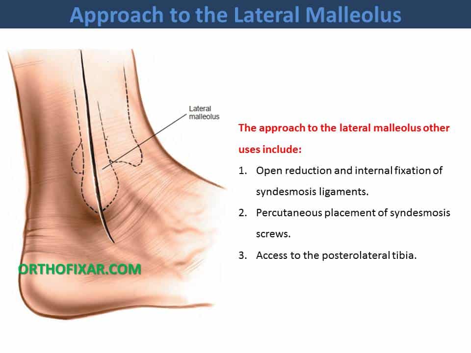  Approach to the Lateral Malleolus 