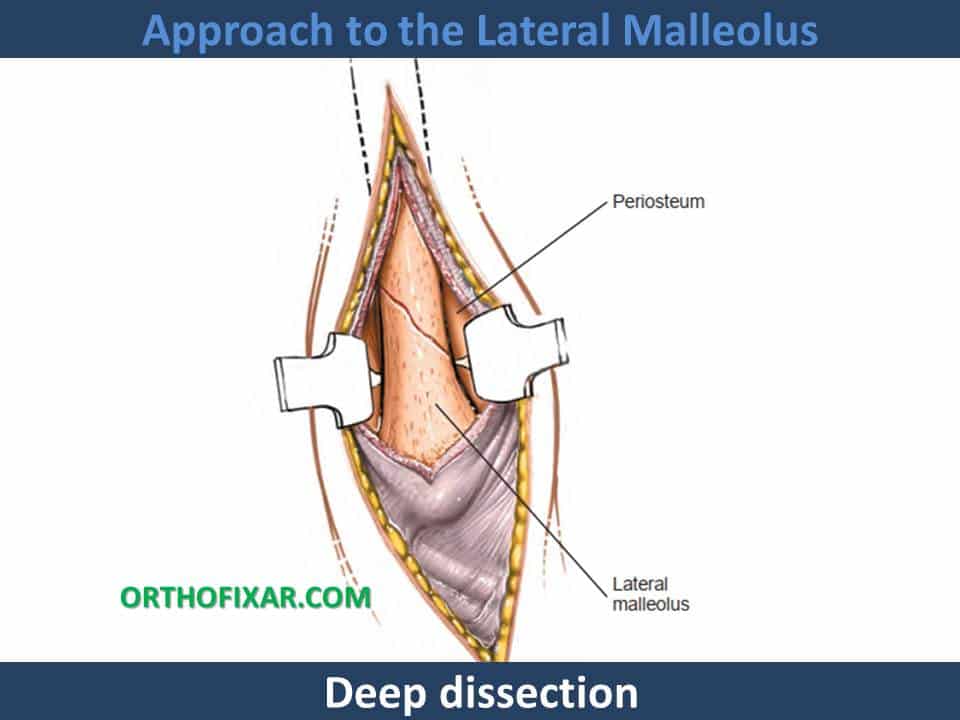 Approach to the Lateral Malleolus