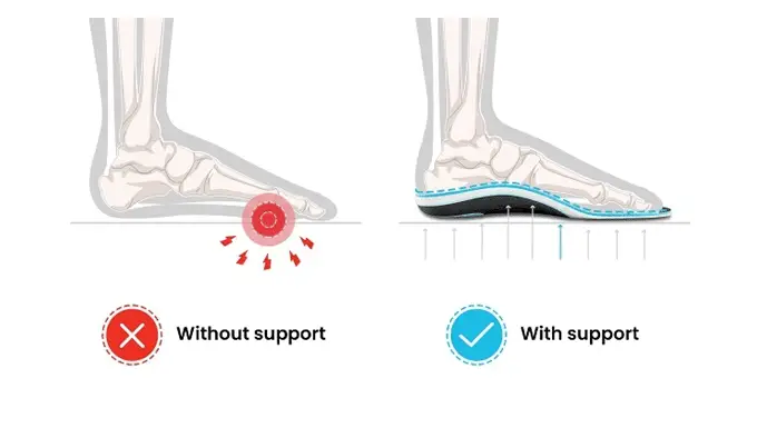 Finding Relief from Morton’s Neuroma with Arch Support Insoles 1 Arch Support Insoles