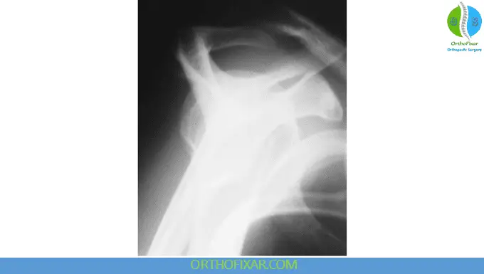 Shoulder X-ray Views 7 Arch view of the acromioclavicular join