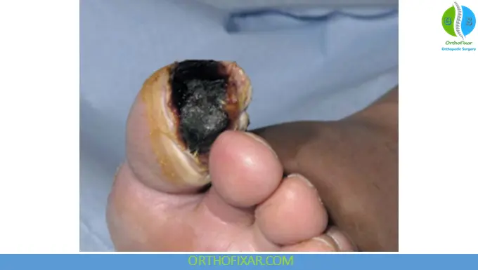 Arterial Insufficiency: Causes, Symptoms & Management 5 Arterial Insufficiency Gangrene