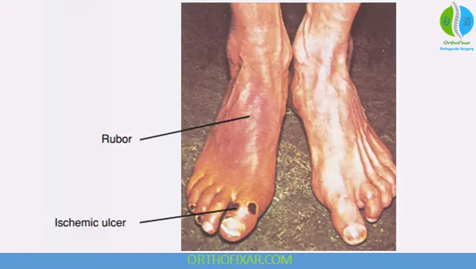Arterial Insufficiency: Causes, Symptoms & Management 4 Arterial Insufficiency ulcer