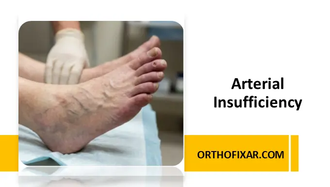 Arterial Insufficiency