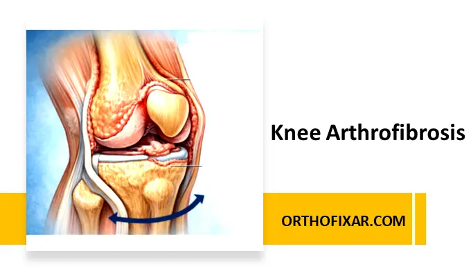 Arthrofibrosis of the knee joint