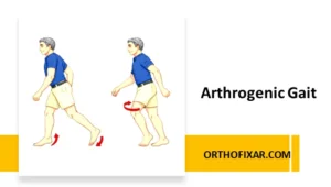 Arthrogenic Gait